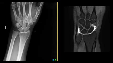 What Is An Mri Wrist Arthrogram Youtube