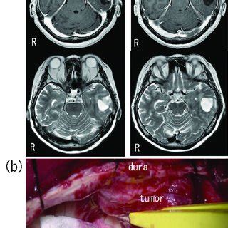 A Preoperative Gadolinium Enhanced T Weighted Magnetic Resonance