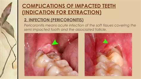 Surgical Removal Of Impacted Teeth Ppt