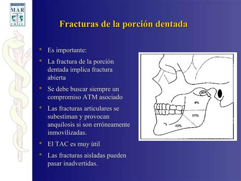 Fracturas Faciales Ppt