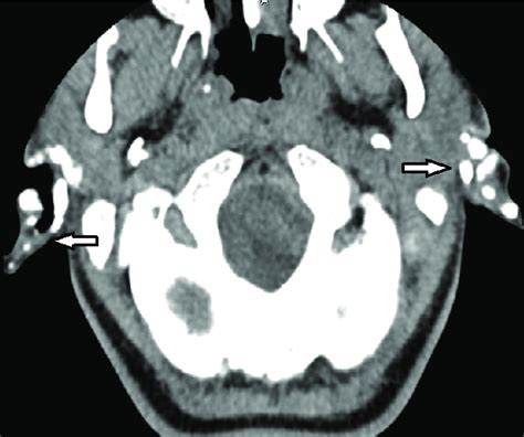 Calcification In Auricular Cartilage Cranial Ct Download Scientific