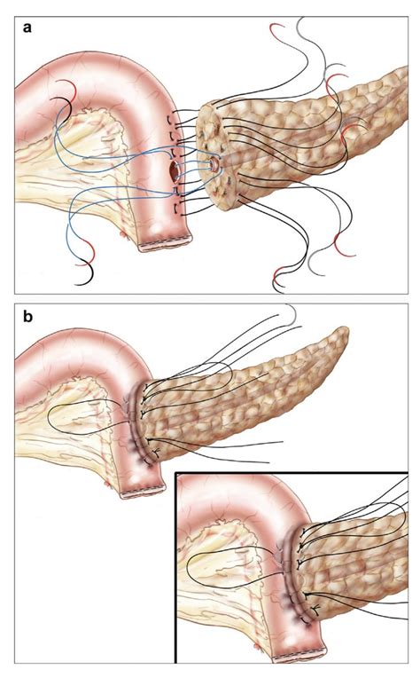 Cirbosque Some Surgery On Twitter Anastomosis With Transfixing