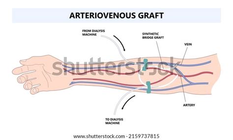 37 Arteriovenous Graft Images Stock Photos Vectors Shutterstock