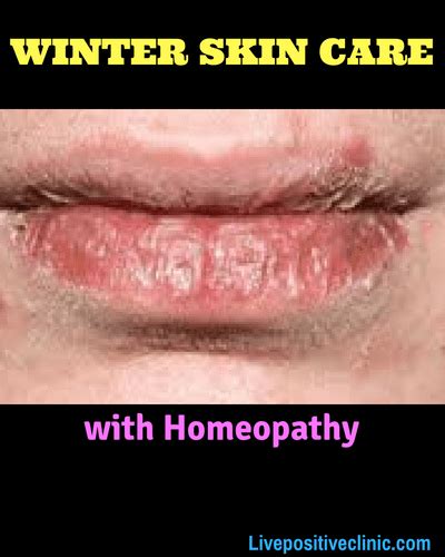 Dry Skin Care in Winter With Homeopathy | Live Positive | Multispeciality Homeopathy