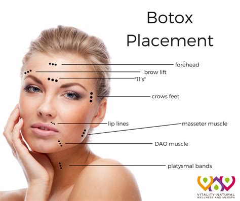 Diagram Botox Lip Flip Injection Points Diagram Botox Lip Fl