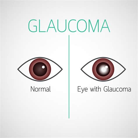 Glaucoma Cos E Come Si Cura Centro Ottico Sodero