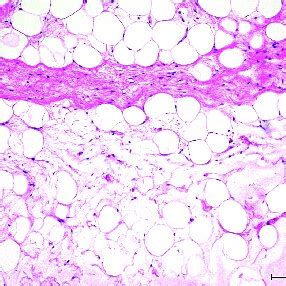 Microscopic Image Of The Tumor Tissue Fig A B The Presence Of Mature