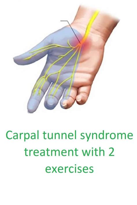 Carpal Tunnel Syndrome Treatment With 2 Exercises Artofit