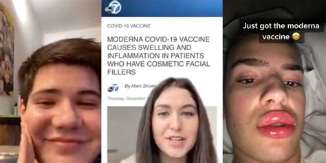 Tiktok Teens With Fillers Realize Moderna Vaccine Might Swell Their Faces