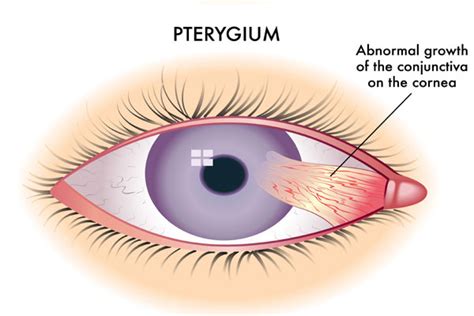 Pterygium Removal Brisbane Do You Have Surfers Eye