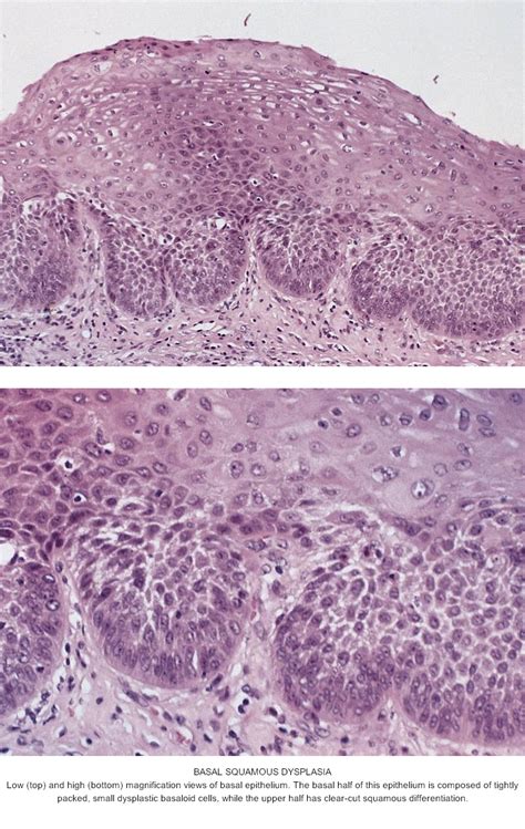 Pathology Outlines Squamous Dysplasia