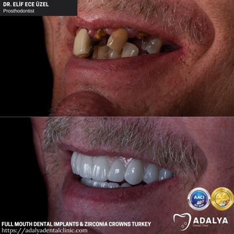 Full Mouth Dental Implants Turkey Package Deals Full Set Implants Cost