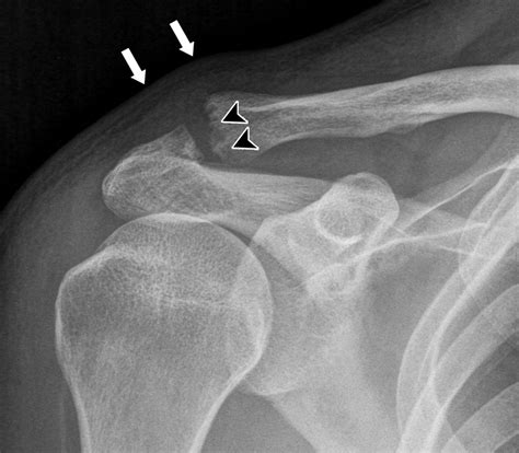 Imaging Of The Acromioclavicular Joint Anatomy Function Pathologic