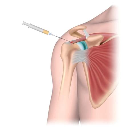 Shoulder Joint Injections Ohio Healthcare Partners