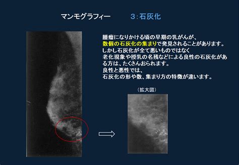 乳がん健診を識る｜ひふみクリニック 埼玉県川口市東領家の内科乳腺外科外科皮膚科総合診断