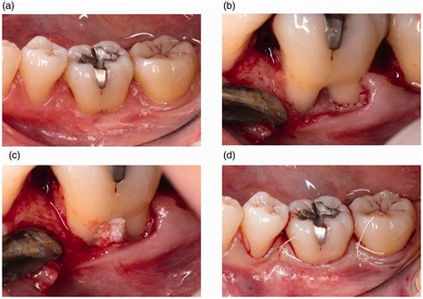 Two Stage Approach For Class Ii Mandibular Furcation Defect With