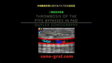 二重超音波検査 末梢動脈疾患におけるバイパスの血栓症 Youtube