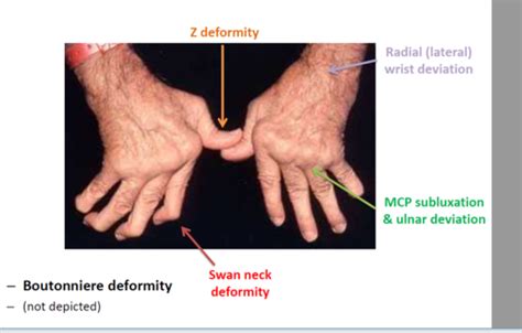 Rheumatoid Arthritis Flashcards Quizlet