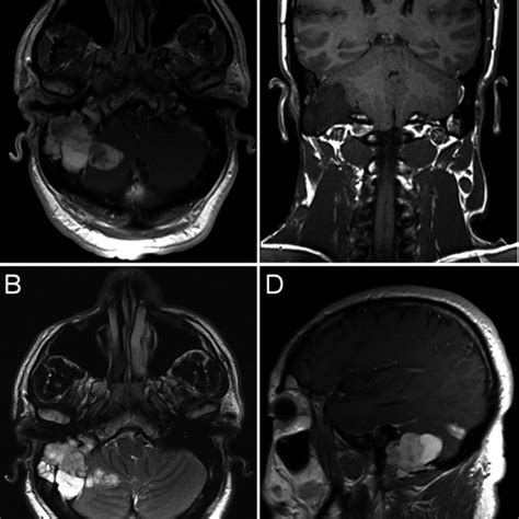 Preoperative Magnetic Resonance Imaging A Axial T1 B Axial T2 Download Scientific