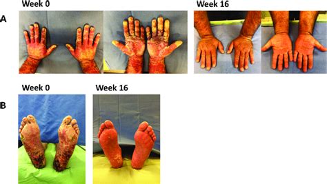 Changes in psoriasis skin lesions during treatment with secukinumab ...