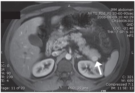 Intrapancreatic Accessory Spleen Mimicking A Pancreatic Endocrine Tumour Cjs