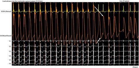 Frontiers Case Report Left Bundle Branch Pacing Guided By Real Time