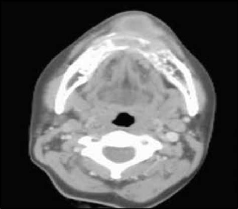 Cranio Facial CT Scan Axial Cut Of Case 2 Showing Advanced Mass In The