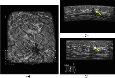 Introduction Of Automated Breast Ultrasound As An Additional Screening