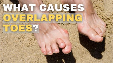 Overlapping Toes Causes And Solutions YouTube