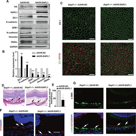 Overexpression Of Dapl Inhibits The Emt Of Rpe Cells In Vitro A B