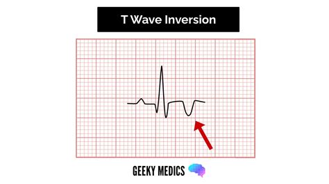 How To Read An Ecg Ecg Interpretation Ekg Geeky Medics