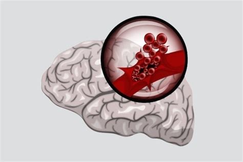 O que é a hemorragia cerebral diagnóstico e como tratar Tua Saúde