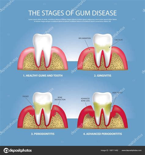 Human Teeth Stages Of Gum Disease Vector Illustration Stock Vector By