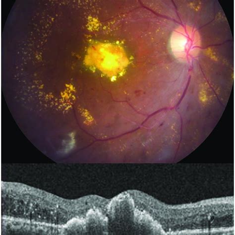 Pdf Vitrectomy With Internal Limiting Membrane Peeling Versus