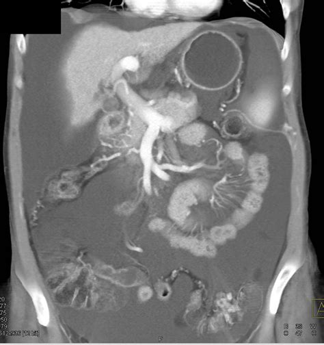 Cirrhosis With And Recanalization Of The Umbilical Vein Liver Case