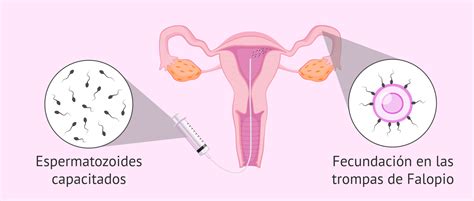 Qu Es La Inseminaci N Artificial Intrauterina