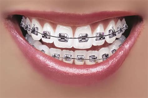 Orthodontics Beautiful Smiles Dental Center