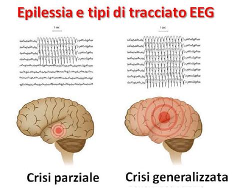 La Sindrome Dell Epilessia Atonica Mioclonica