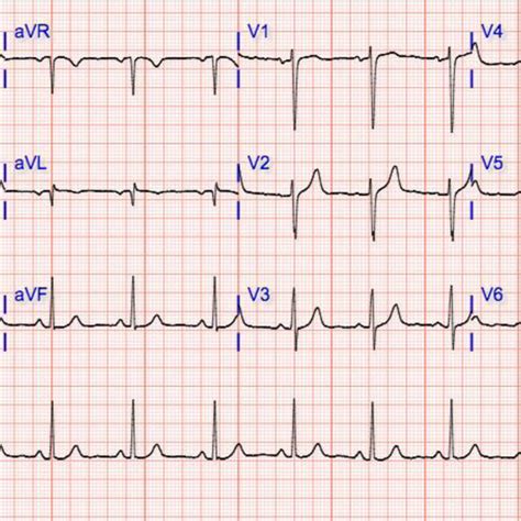 Repeat 12 lead EKG showing normal sinus rhythm. | Download Scientific ...