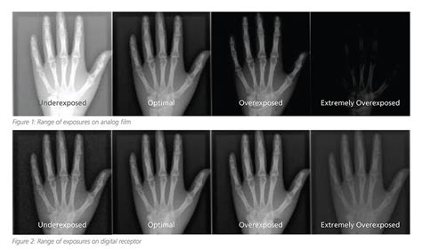 Understanding Radiology Exposure Indicators Everything Rad In 2023