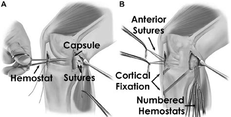 Illustrations Of A Medial Meniscal Allograft Transplantation For A