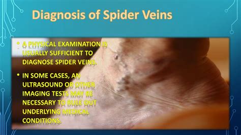 PPT Understanding Spider Veins Causes Symptoms And Treatment Options