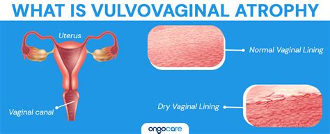 Vulvovaginal Atrophy: Causes, Symptoms, Treatment - Ongo Care