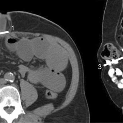 Hernia characteristics measured on CT scan, such as longitudinal hernia... | Download Scientific ...