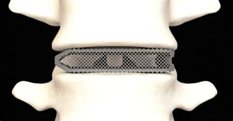 Fda Clears New Surgeon Inspired 3d Printing Device For Lumbar Fusion Alicia Bell Ifbb Pro And