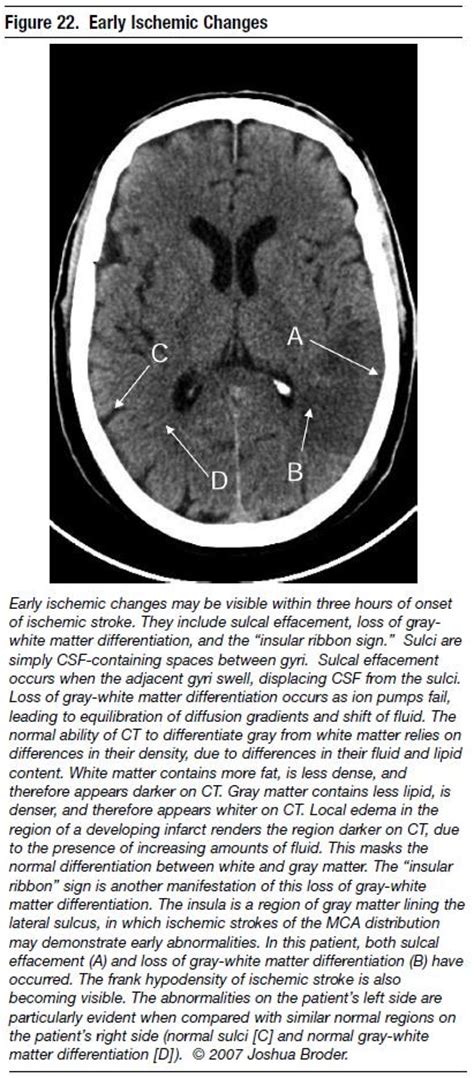 Ischemic: Brain Ischemic Changes