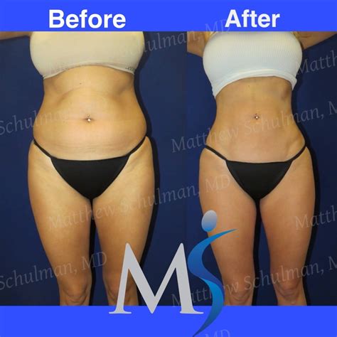 Yes You Can Get 360 Lipo Without Tummy Tuck Surgery Matthew Schulman