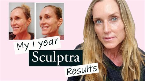 My 1 Year Sculptra Update With BEFORE AFTER Pictures Is Sculptra