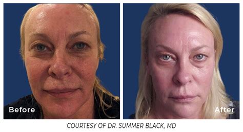 Erbium Laser Resurfacing Scientiphika Medspa Rhode Island