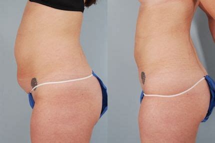 UltraSonic Liposuction Alert Liposuction Lipo Before And After Lipo